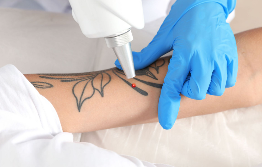 Tattoo Removal Near Me